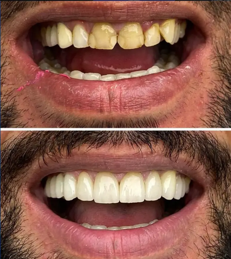 Sorriso antes e depois - caso 1