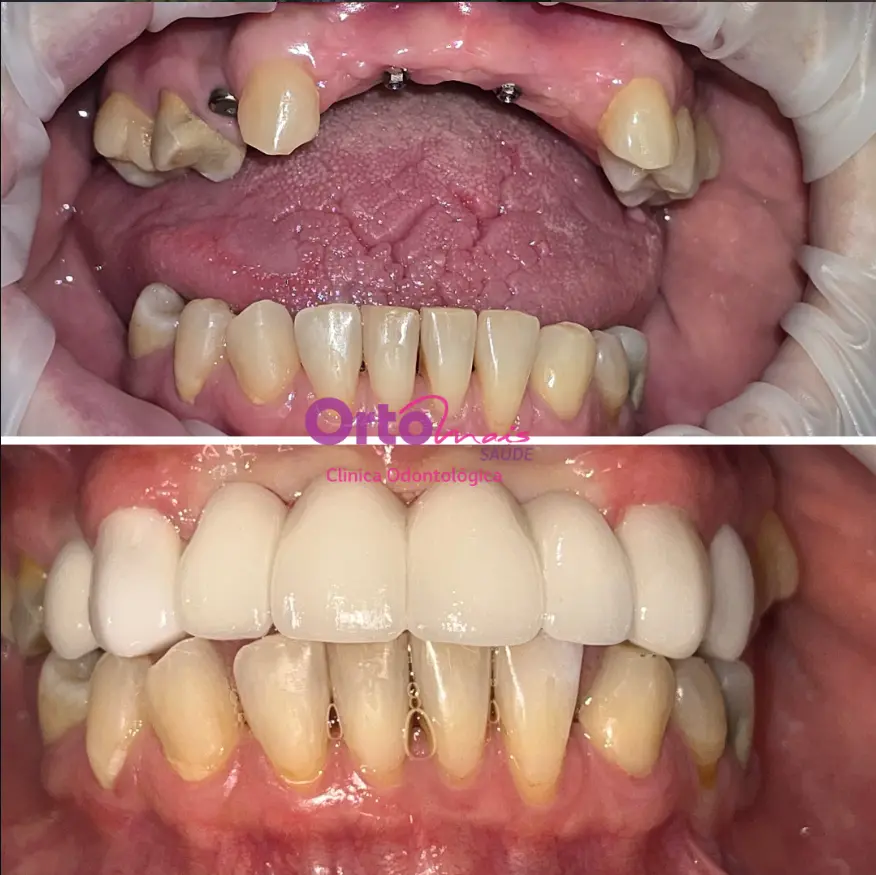 Dentes antes e depois - caso 2