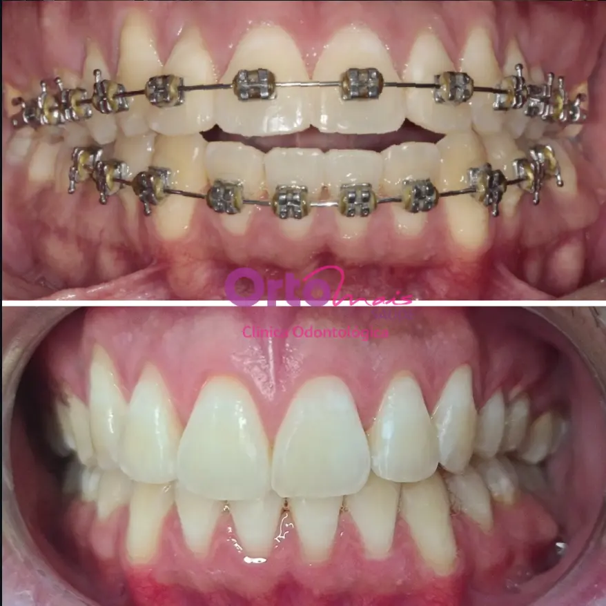 Sorriso antes e depois - caso 3