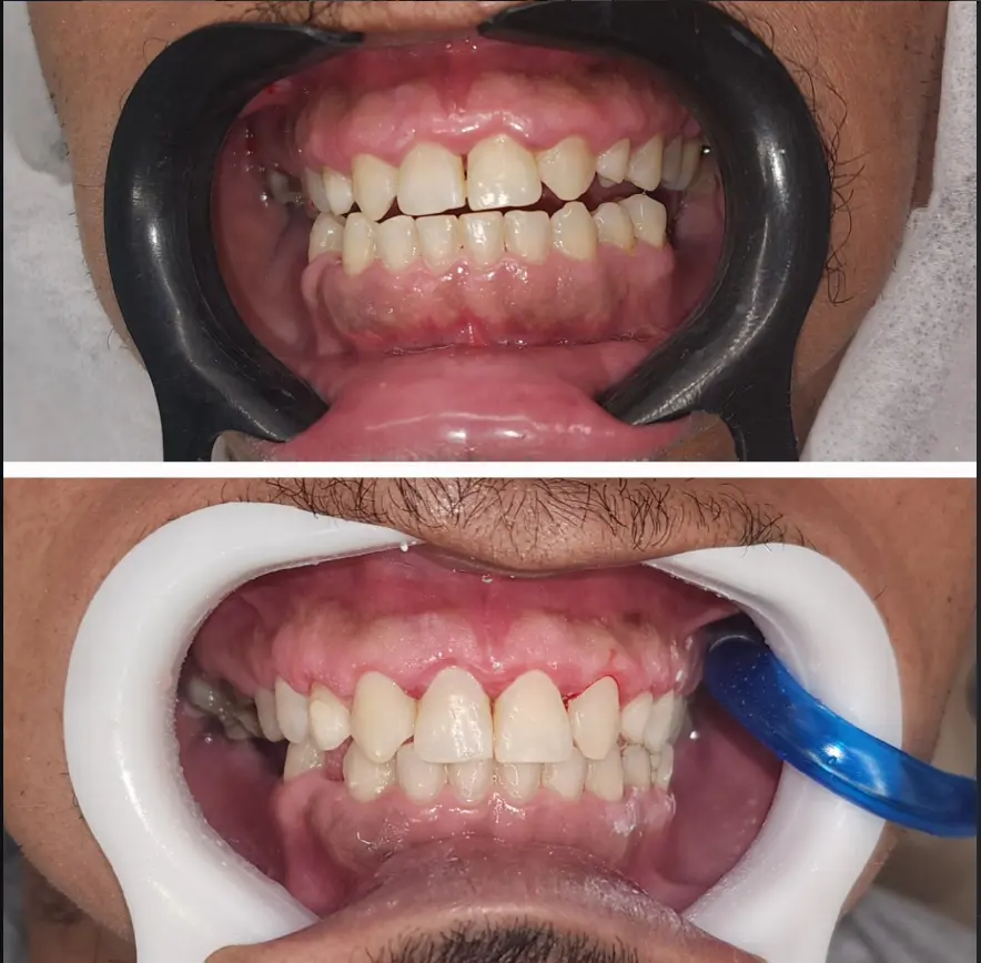 Antes e depois - caso 4